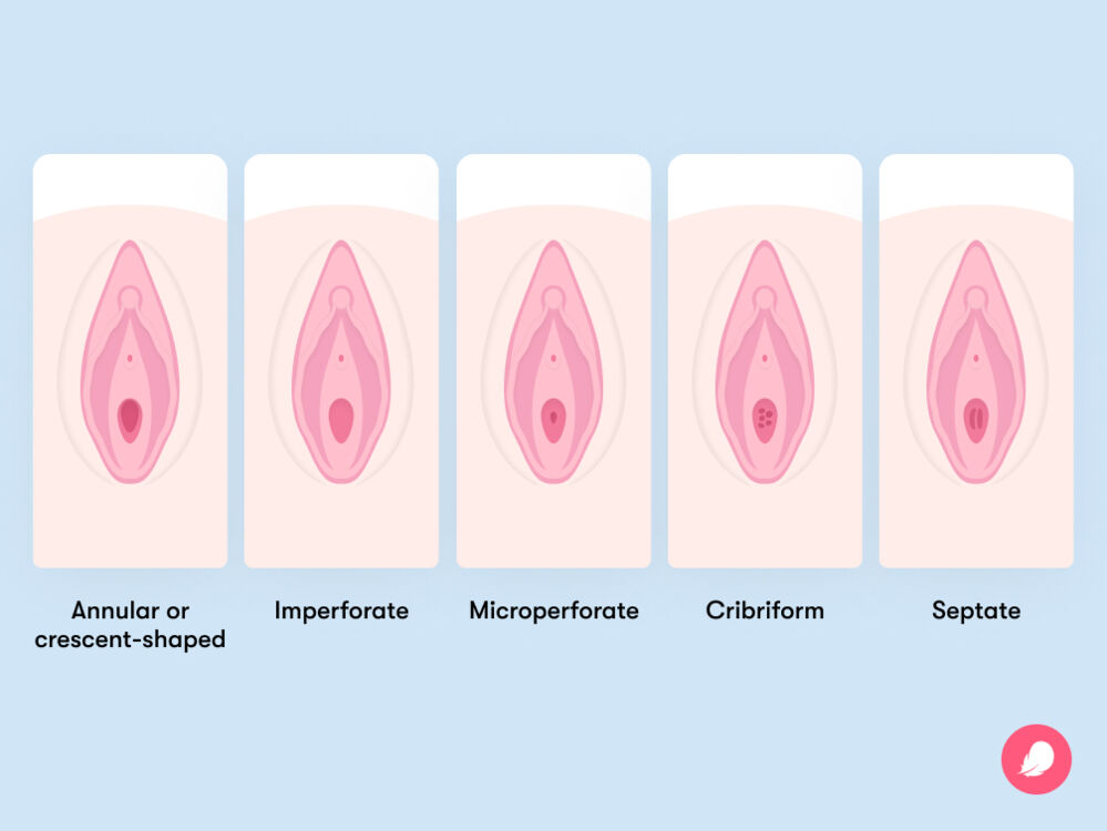 What is a hymen and what does it look like Flo